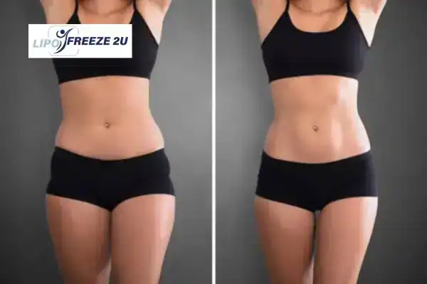 How Can LIPO FREEZE 2U Support Your Post-Pregnancy Body Recovery Leighton Buzzard?