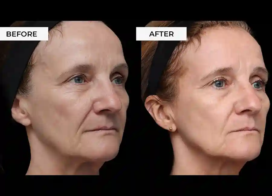 How Many RF Microneedling Sessions Will You Need to See a Difference Leighton Buzzard?