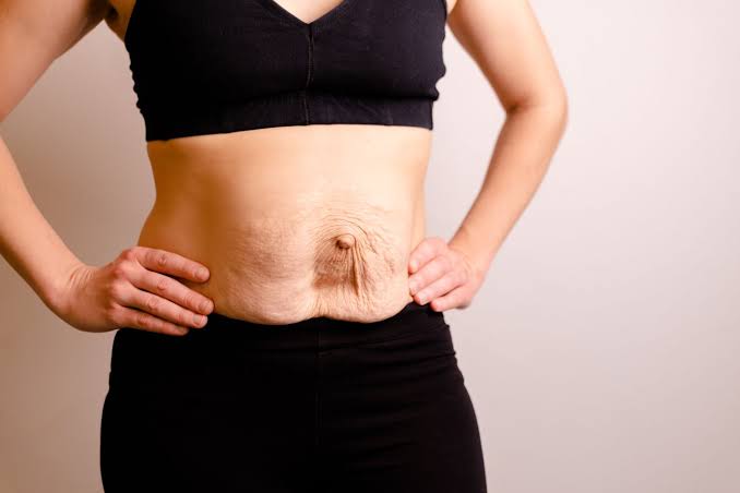 Is Surgery Really the Only Way to Repair Diastasis Recti Leighton Buzzard?