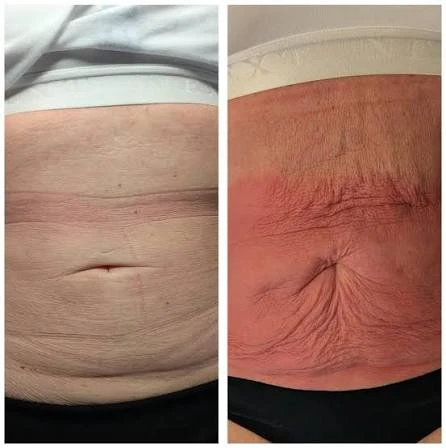 How Does RF Microneedling Improve Crepey, Thin and Uneven Skin Texture Leighton Buzzard?
