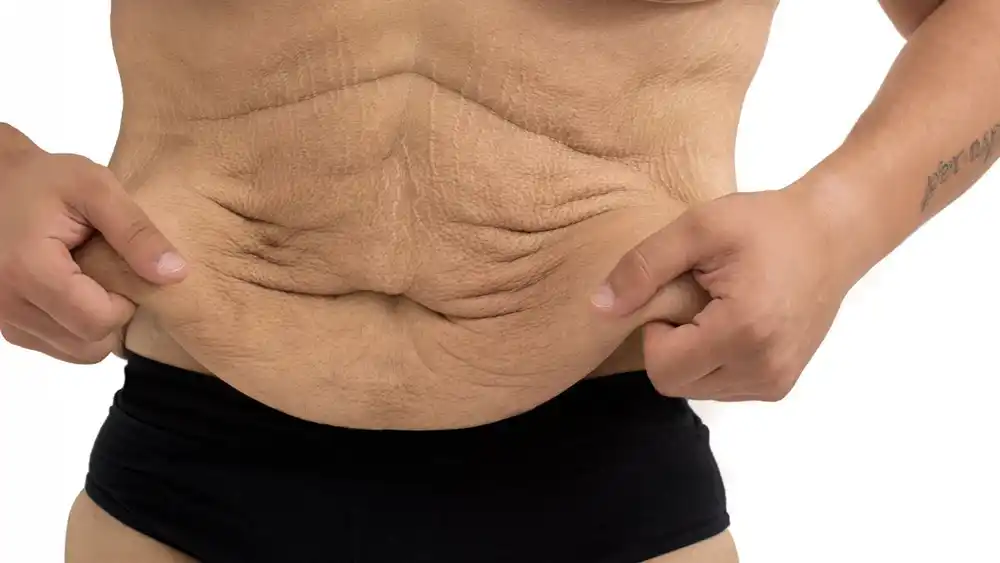 Why Does Weight Loss Medication Leave Some People With Loose or Sagging Skin Leighton Buzzard?